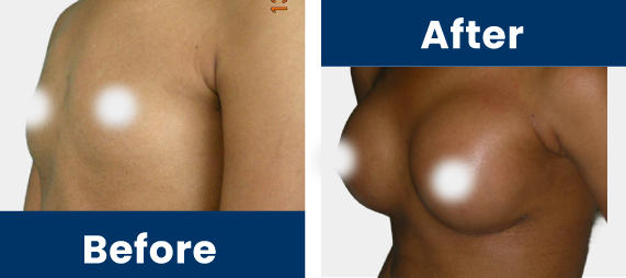 Breast-Augmentation-Slider-D