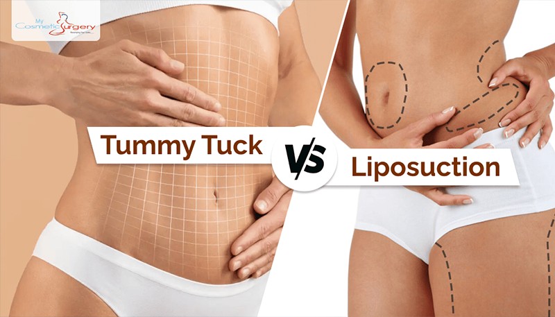 Abdominal body contouring procedure showing tummy tuck benefits