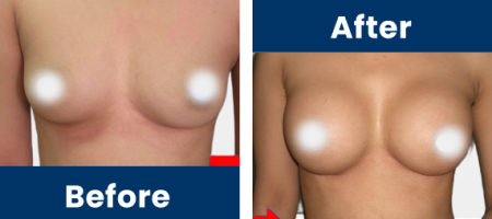 Breast-Augmentation-Slider-A
