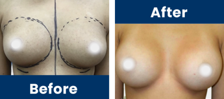 Breast-Augmentation-Slider-B