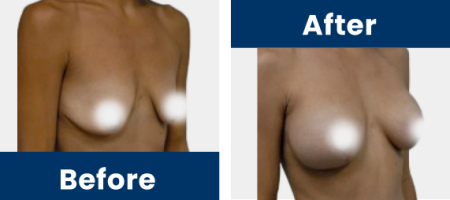 Breast-Augmentation-Slider-C